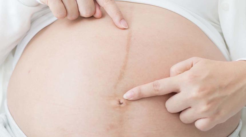 Karındaki kahverengi çizgi sadece hamilelerde olmaz! Hastalığa karşı hazırlıklı olun