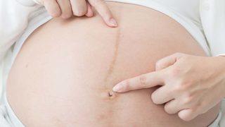 Karındaki kahverengi çizgi sadece hamilelerde olmaz! Hastalığa karşı hazırlıklı olun