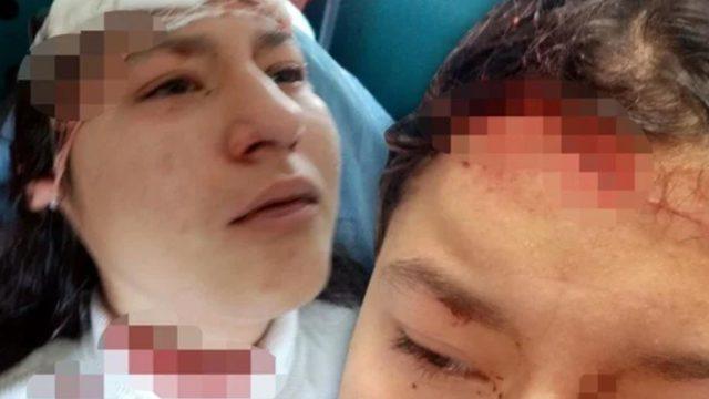 Kastamonu'da korkunç olay! Sokak köpekleri İmran'ın yüzünü parçaladı