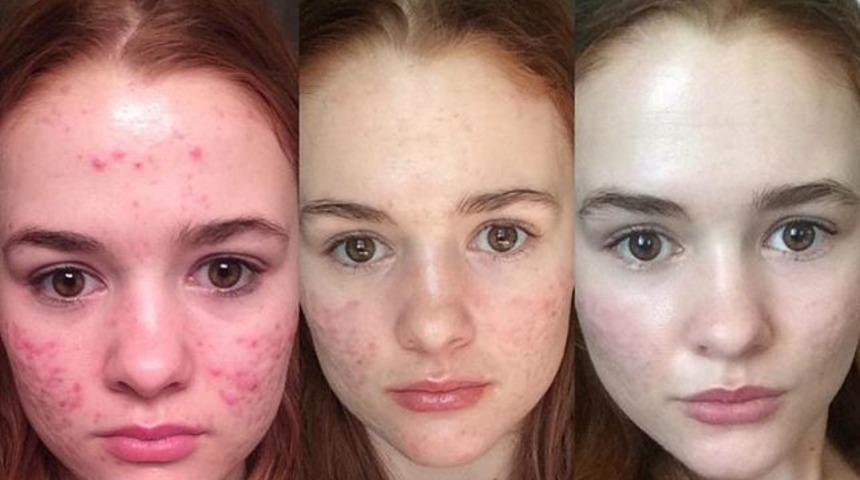 Roacctune tedavisi g&ouml;ren kızın &ouml;ncesi sonrası fotoğraflarıyla sivilcelerinden kurtuluş hikayesi