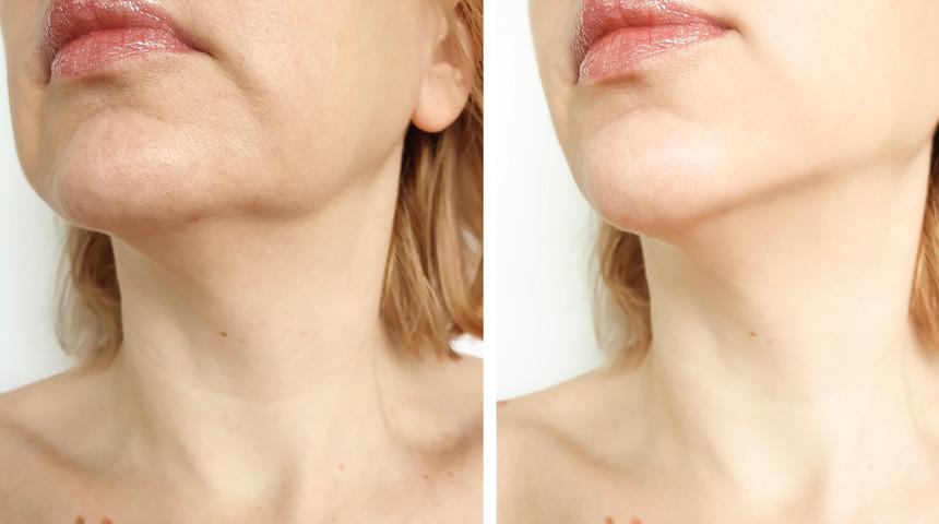 Gençleşmede yeni trend: Trinity lift uygulamasının avantajları nelerdir?