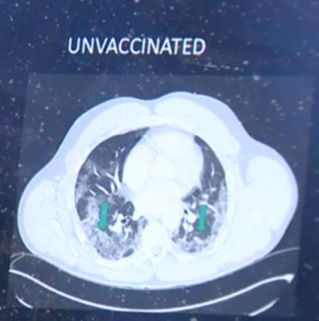 Aşısız hastanın röntgen sonucu