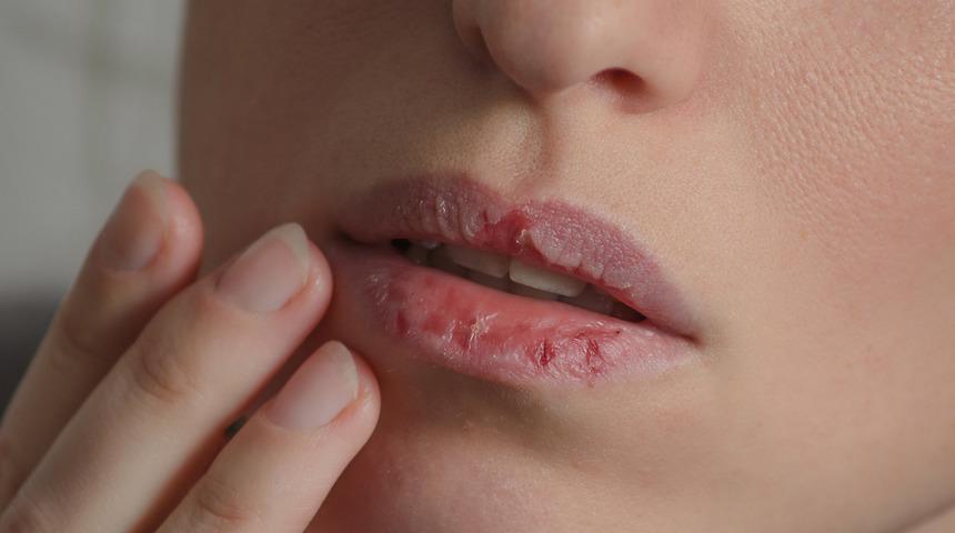 Ağız kuruluğunu hafife almayın! Başınıza çok dert açabilir