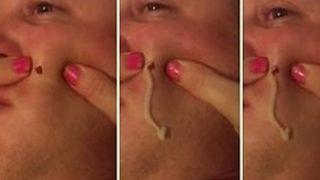 Eşinin yüzündeki kisti patlattı! Görenler gözlerine inanamadı