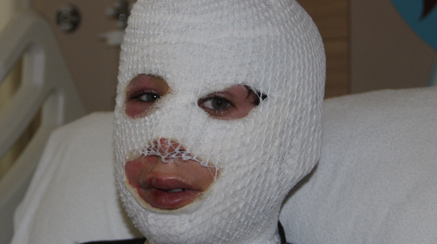 Facia! 13 yaşındaki Yunus'u hem soba yaktı, hem kaynar su