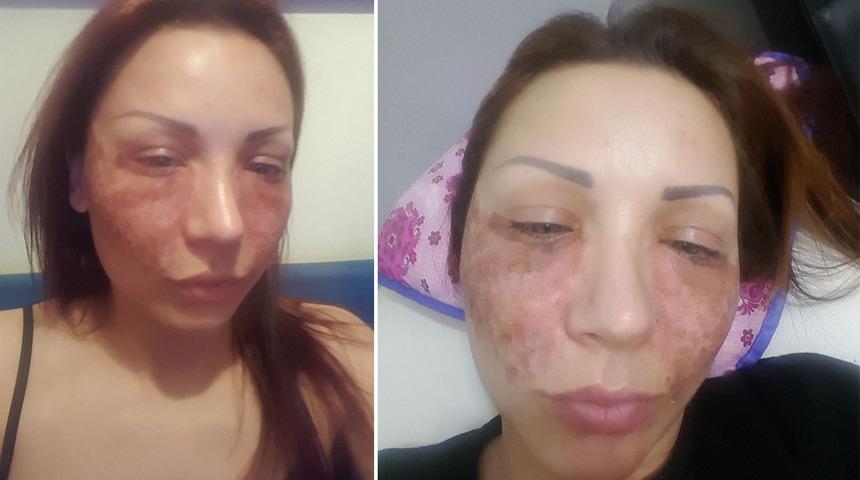 Bulgar modelin estetik kabusu! Kuaf&ouml;rde "&ouml;r&uuml;mcek ağı" estetiği yaptırdı, hayatının şokunu yaşadı