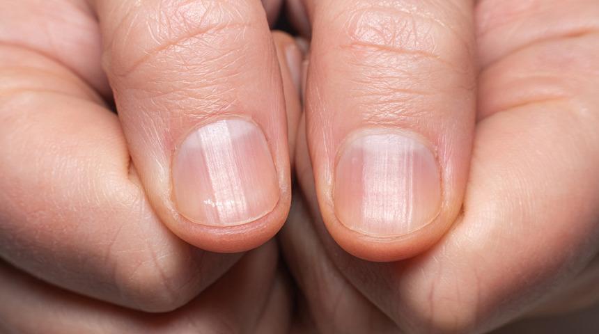 Tırnaklardaki çizgiler ne anlama gelir? Belki de doktora gitme vaktiniz gelmiştir