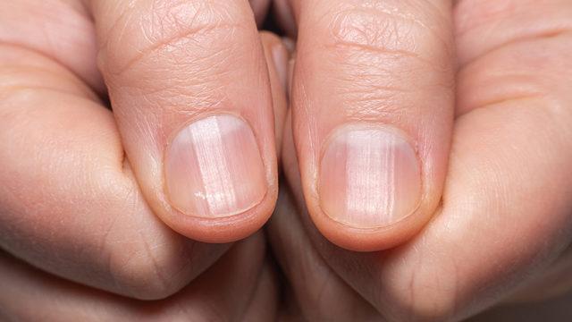 Tırnaklardaki çizgiler ne anlama gelir? Belki de doktora gitme vaktiniz gelmiştir