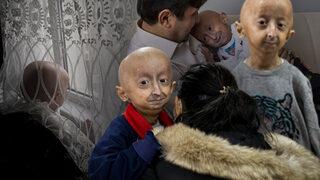 Dünyada çok nadir görülüyor, Türkiye'de 4 kişide var! 9 yaşındaki Veysel tedavisi olmayan hastalıkla mücadele ediyor