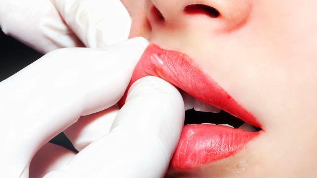 Yaptırmadan önce bir kez daha düşüneceksiniz! Dudağa enjekte edilen dolgu gerçekte nasıl görünüyor?