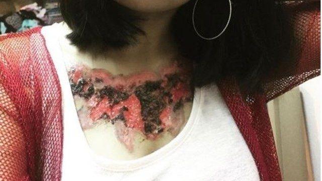 Dövmeyi sildirince bu hale geldi (+18)