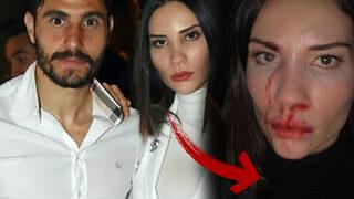 Mihriban Hurmacı'nın 'Kanlı yüzümü tekmelerken çocuklarım gördü' açıklamasına Özer Hurmacı'dan yalanlama! Hepsi yalan, o beni ısırdı