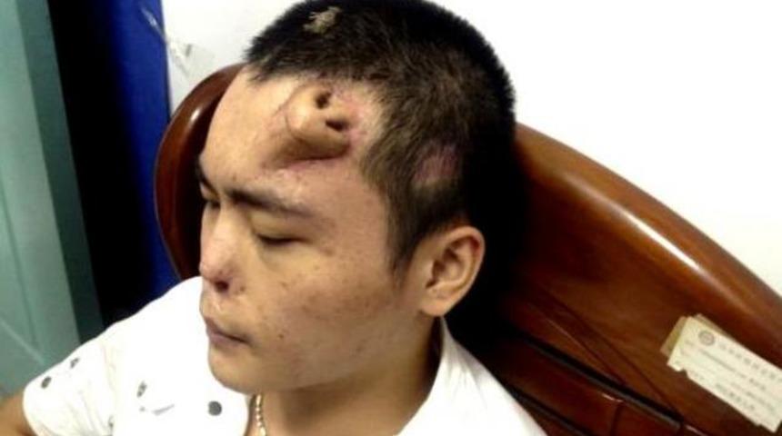 Alnında burunla yaşıyor