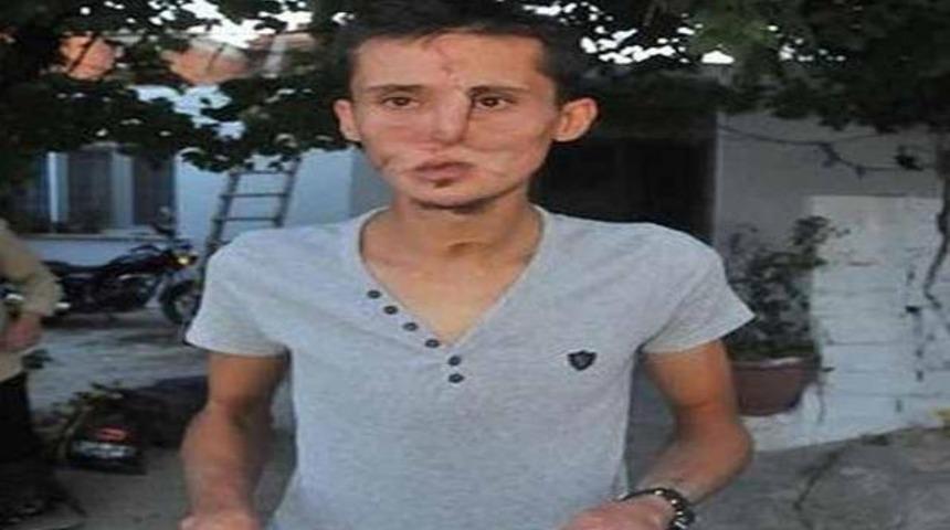 Yüz nakli sevinci 2 saat sürdü