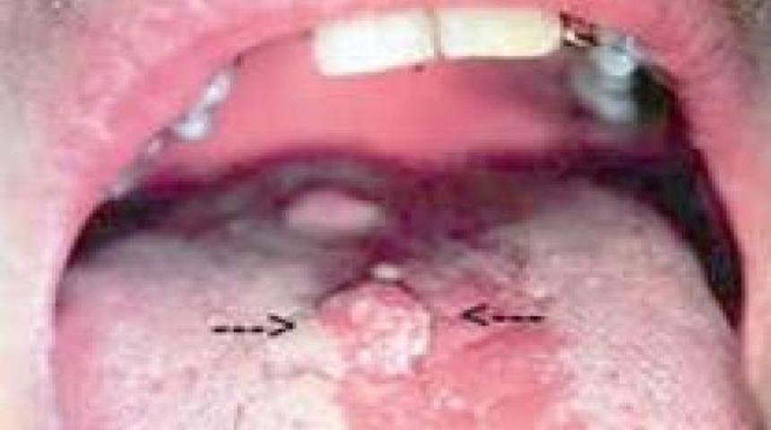 Oral seks ve hpv vir&uuml;s&uuml;