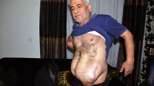 Ameliyatta kullanılan teli içeride unuttular, oluşan karpuz büyüklüğünde şişkinlikle hayatı kabusa döndü