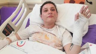 Kafedeki yangında dehşeti yaşadı, 45 gün yoğun bakımda kaldı: Son 2 ayı hatırlamıyorum