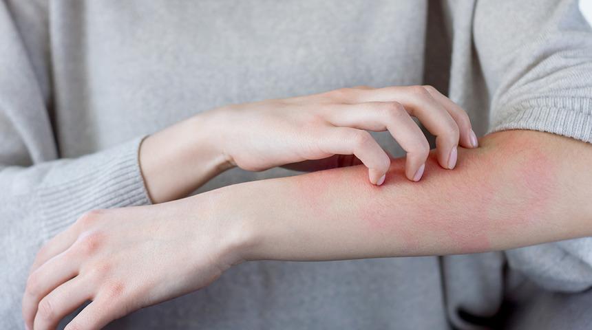 Kaşıntınızın nedeni alerji olabilir... Ciddi sorunlar yaratıyor!