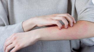 Kaşıntınızın nedeni alerji olabilir... Ciddi sorunlar yaratıyor!