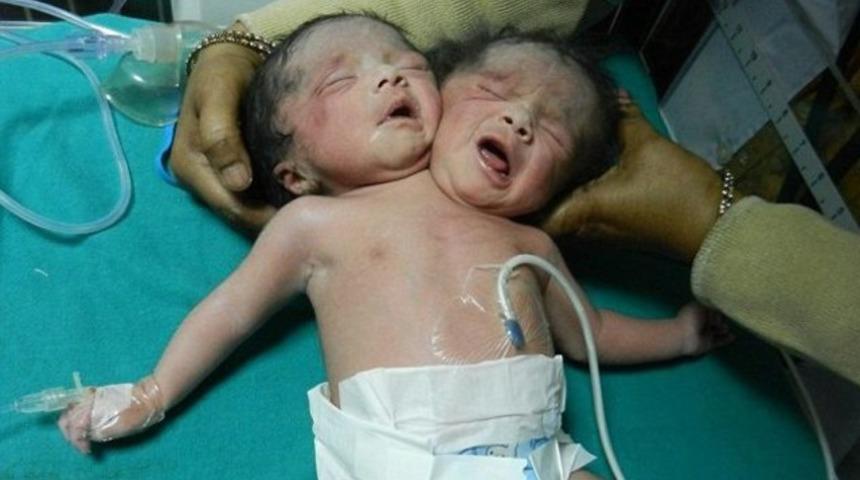 Hindistan'da yapışık ikizler doğdu