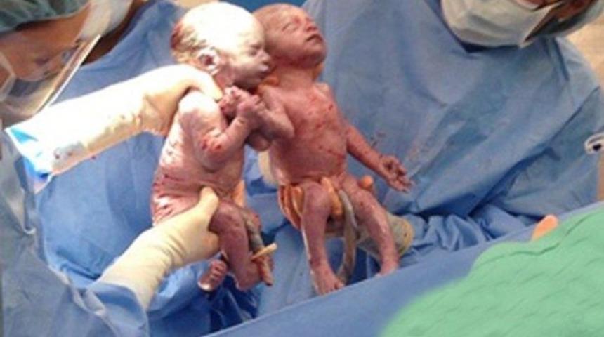 B&ouml;ylesi 10 binde 1: İkizler el ele doğdular