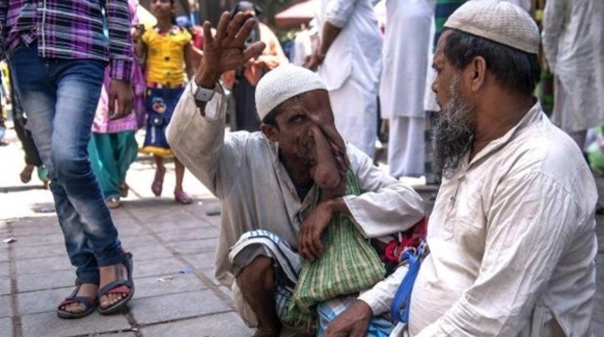 'Fil adam' ameliyatı reddetti