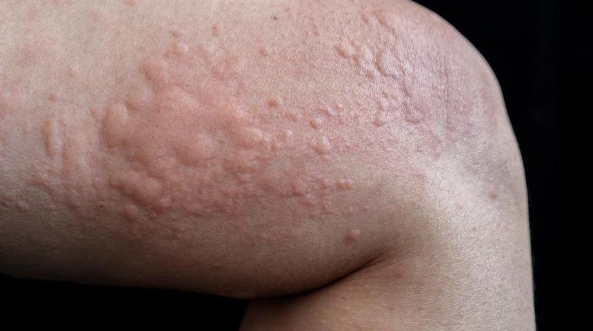 Bu izler Covid-19 belirtisi olabilir!