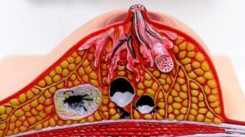 Meme kanserinde yeni ila&ccedil; "umut" veriyor