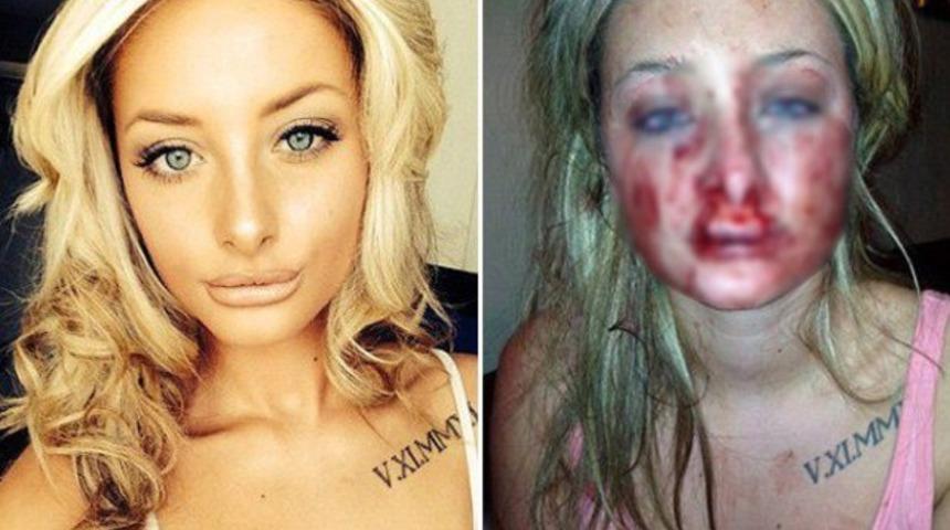 Kız arkadaşını öperken dudağını kopardı