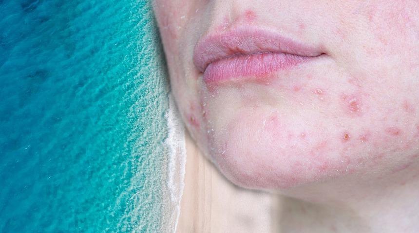 Deniz tuzu sivilcelere karşı söylendiği kadar etkili mi? Yanıtına inanamayacaksınız