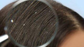 Kepek sorunu ev yapımı karışım sayesinde tarihe karışıyor