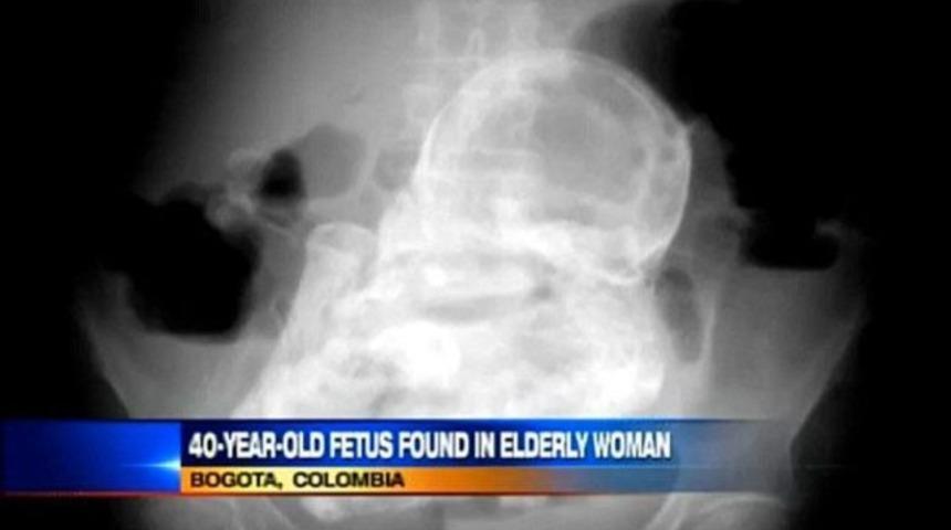 44 yıldır içinde bebek taşıyor