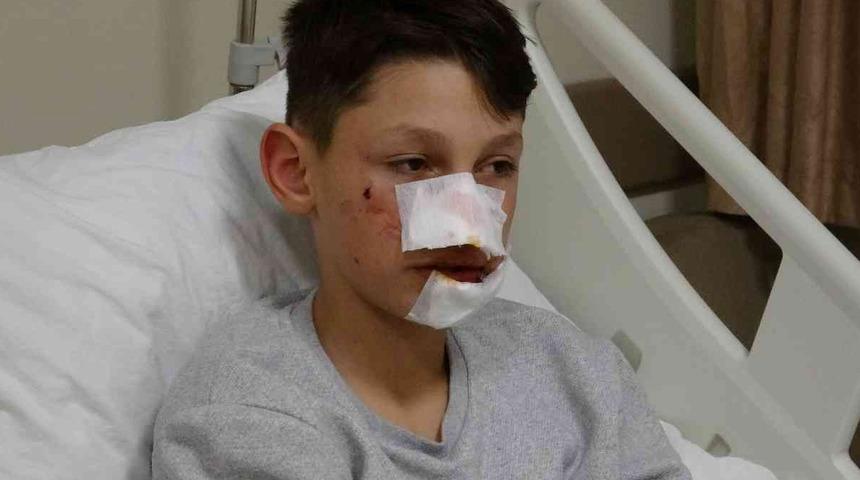 12 yaşındaki çocuk ekmek almaya giderken köpek saldırısıyla bu hale geldi! "Direkt yüzüme saldırdı"