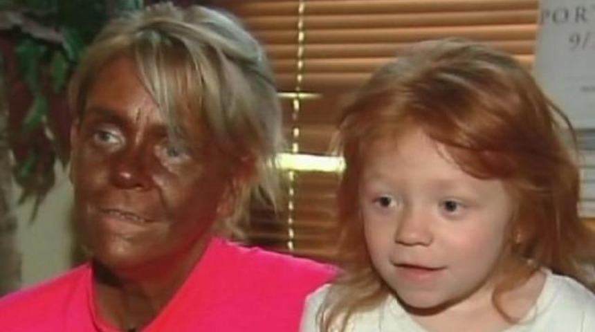 Solaryum bağımlısı hastaneye kaldırıldı