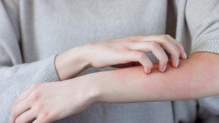 Bu önlemlere dikkat! Egzamadan korunabilirsiniz