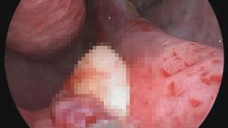 Nefes darlığı çeken adam, burnunda büyüyen dişi öğrenince şoke oldu