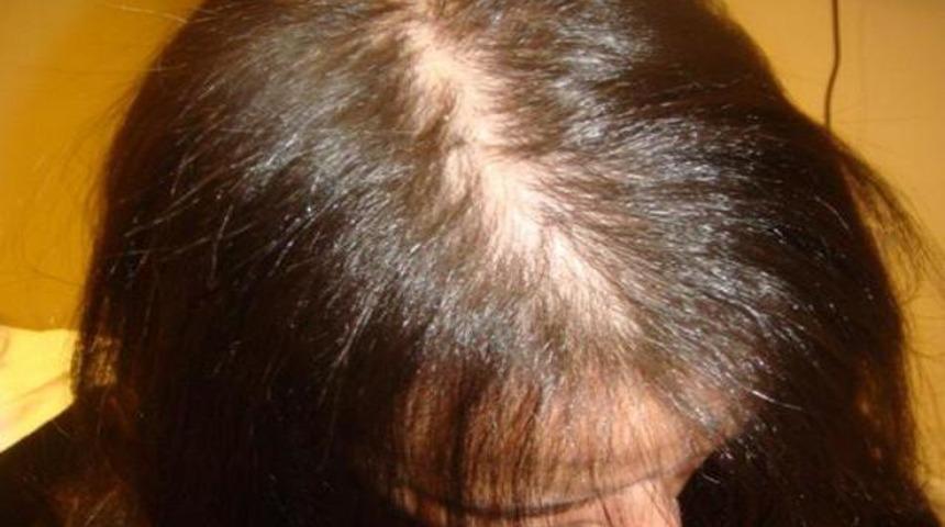 Kadınlarda sa&ccedil; d&ouml;k&uuml;lmesi nedenleri