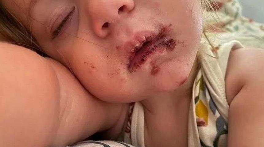 Annesinin yaptığı hata, bebeği bu hale getirdi! Yüzü mahvoldu