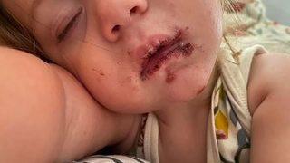 Annesinin yaptığı hata, bebeği bu hale getirdi! Yüzü mahvoldu