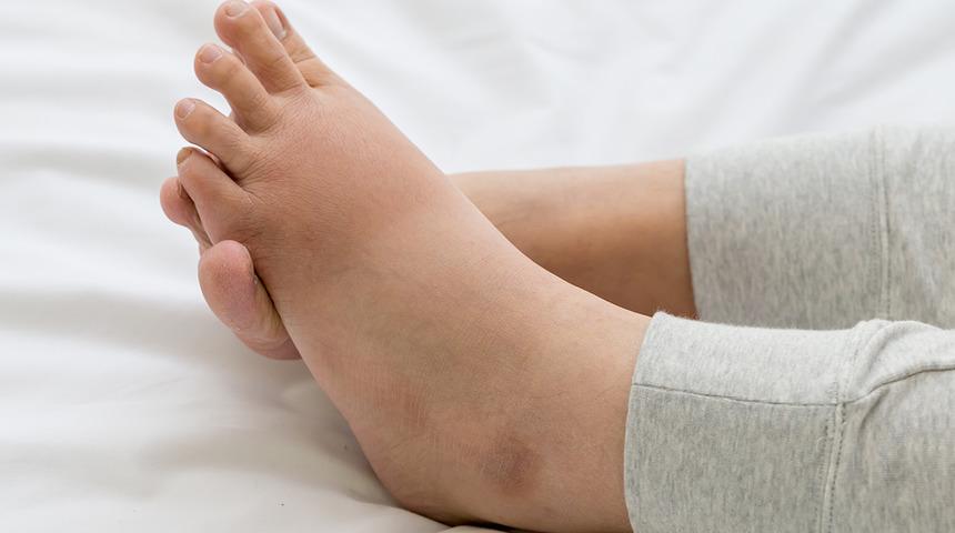 Bunları yiyerek ödem ve şişkinliklerden kurtulabilirsiniz 