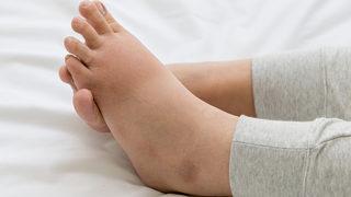 Bunları yiyerek ödem ve şişkinliklerden kurtulabilirsiniz 