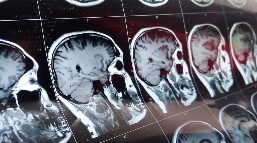 Sonuçları hayrete düşürdü! Ölmesine rağmen beyin aktivitesi devam etti