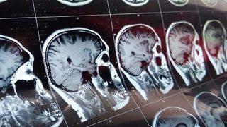 Sonuçları hayrete düşürdü! Ölmesine rağmen beyin aktivitesi devam etti