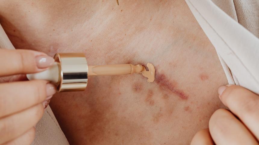 Yara izlerinden o doğal y&ouml;ntemlerle kolayca kurtulabilirsiniz! Yapmanız gereken tek şey...