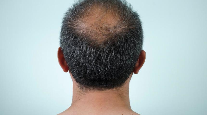 Kök hücreli saç ekimi ile kelliğe veda edin