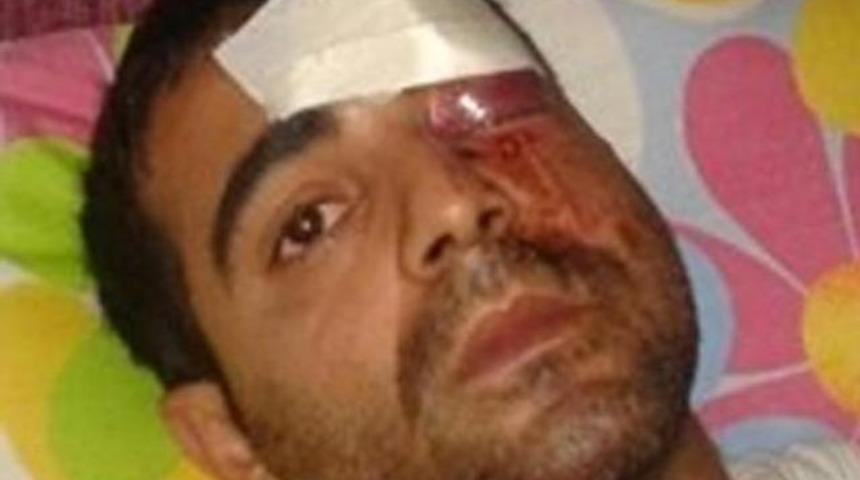 Bir göz kaybı daha