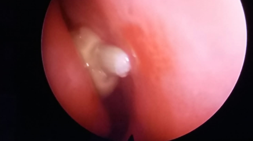 Akıl alır gibi değil! Sosyal medyada gördü, burnuna sarımsak soktu