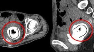 10 yıl boyunca vajinasında vibratör unuttu