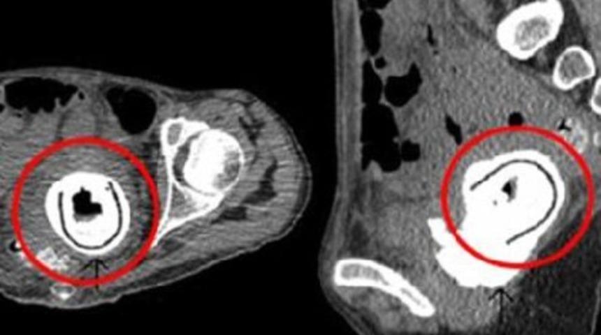 10 yıl boyunca vajinasında vibratör unuttu