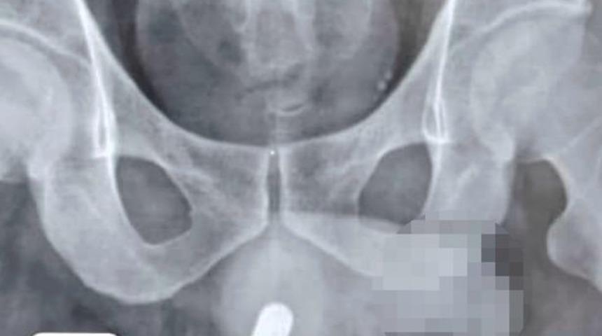 İnanılır gibi değil! Sosyal medyada görünce cinsel organında denedi, soluğu hastanede aldı